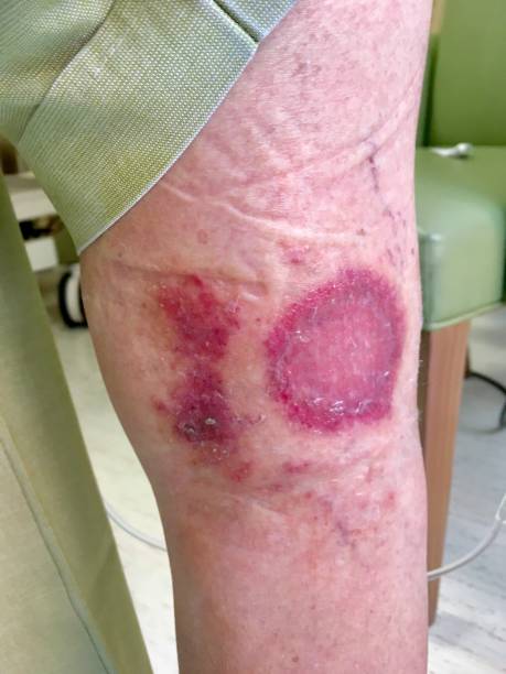 istock Skin lesions on leg 1224961064