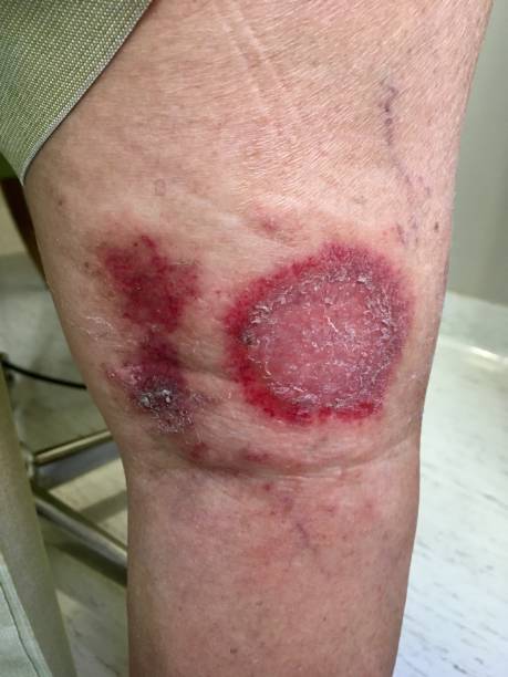 istock Skin lesions on leg 1224961125