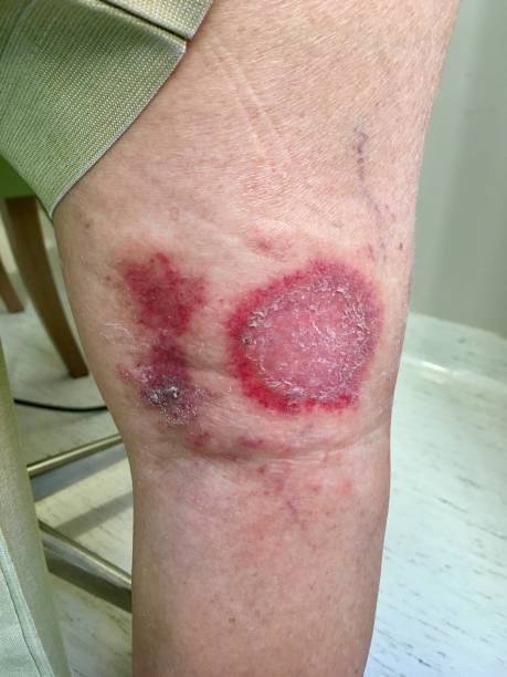 istock Skin lesions on leg 1224961139