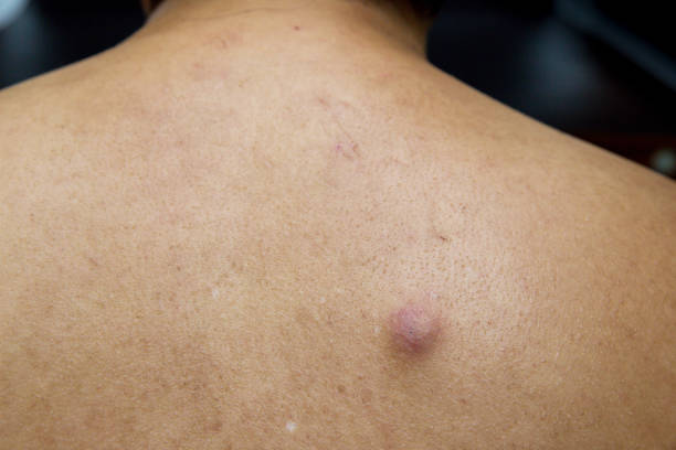 istock Big red pimple on man back, look like an abscess 1224988745