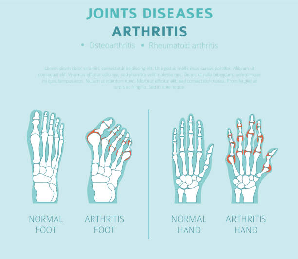 illustrations, cliparts, dessins animés et icônes de maladies articulaires. symptômes d’arthrite, ensemble d’icônes de traitement. conception infographie médicale - human skeleton people human spine human bone