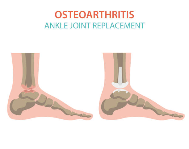 illustrations, cliparts, dessins animés et icônes de arthrite, conception infographie médicale d’arthrose d’arthrose. remplacement articulaire, implantant - human skeleton people human spine human bone