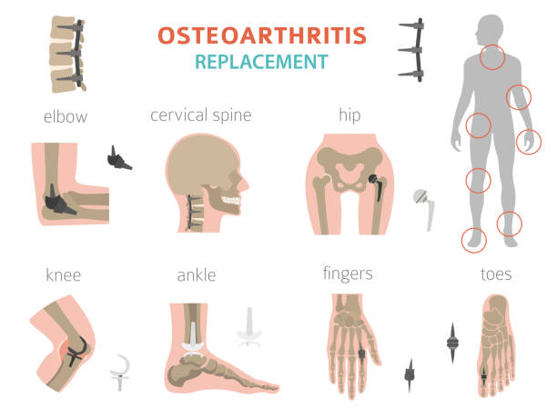 illustrations, cliparts, dessins animés et icônes de arthrite, conception infographie m�édicale d’arthrose d’arthrose. remplacement articulaire, implantant - human skeleton people human spine human bone