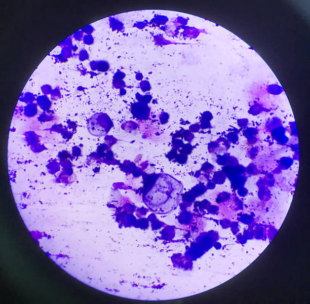 istock Atypical cells in body fluid smear.Laboratory science concept. 1225123841