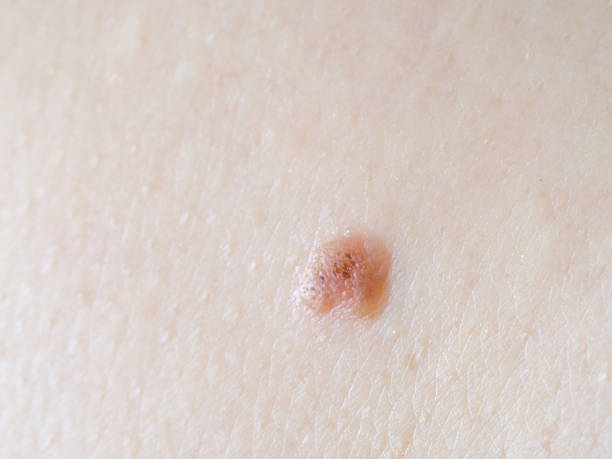 istock Fibroma on human skin, close up 1225154919