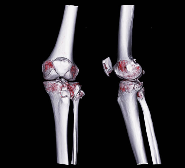 ct kolano renderowania 3d obraz ap i widok boczny izolowane na czarnym tle . - lateral condyle zdjęcia i obrazy z banku zdj�ęć