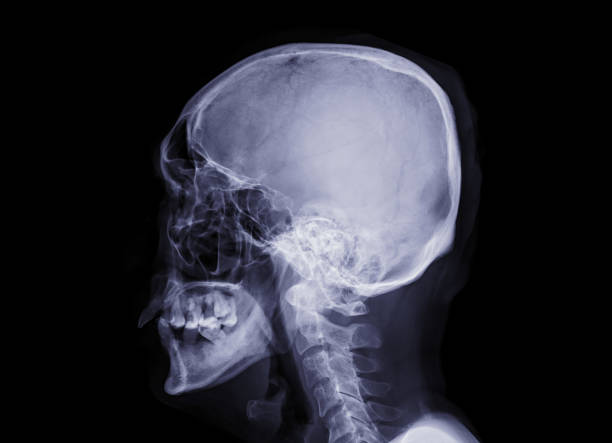 istock Skull x-ray image of Human skull  Lateral  view  isolated on Black Background. 1225228208