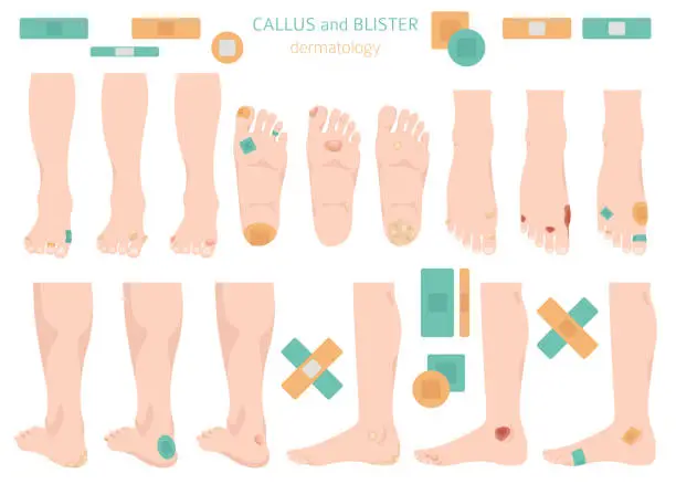 Vector illustration of Callus, corn and blister feet and hands. Dermatology. Medical desease infographics collection