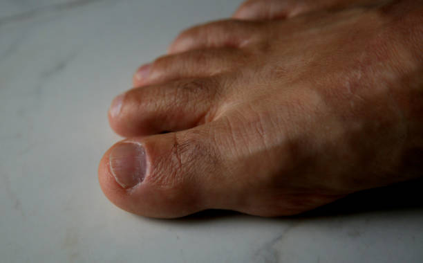 zehennagel - fungus toenail human foot onychomycosis stock-fotos und bilder