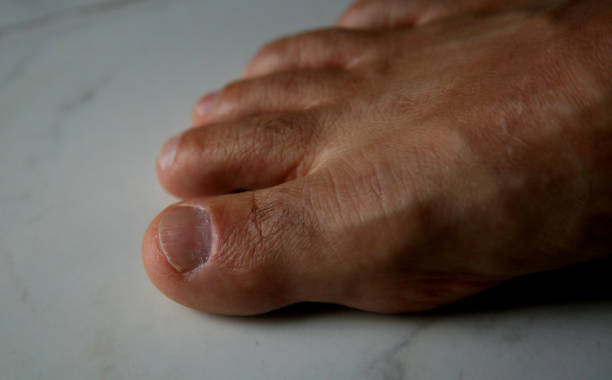 prego do dedo do pé - fungus toenail human foot onychomycosis - fotografias e filmes do acervo