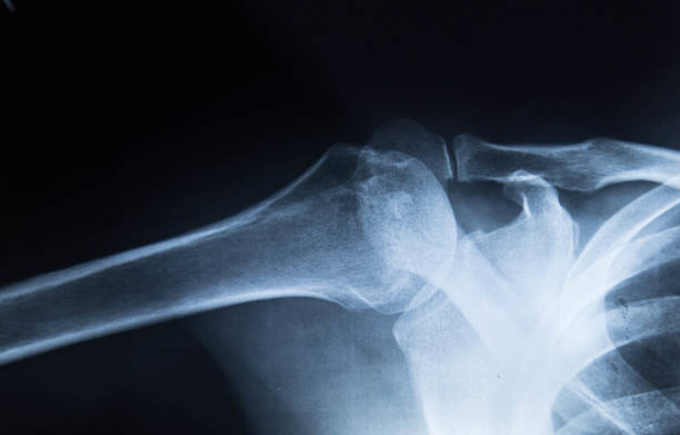 fracture left clavicle - x ray x ray image shoulder human arm imagens e fotografias de stock