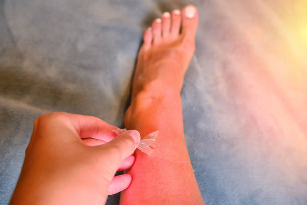 Burnt red skin on the legs after sunburn, real photo Burnt red skin on the legs after sunburn, real photo Sun Poisoning Rash stock pictures, royalty-free photos & images