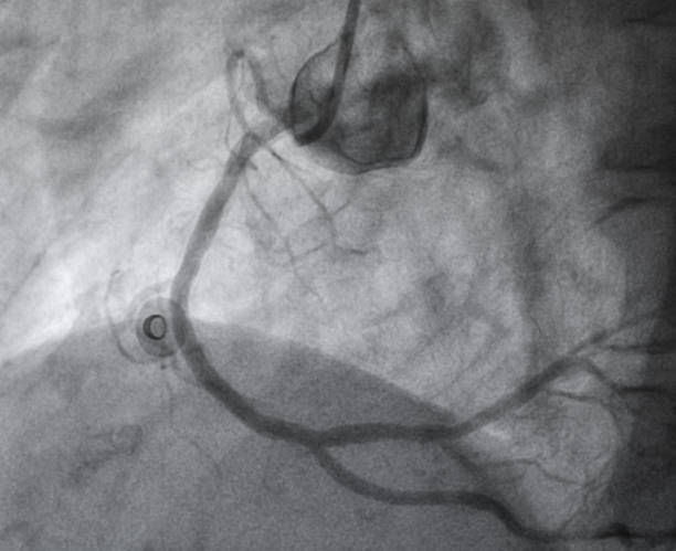 koronare angiographie , rechte koronare angiographie - human heart heart attack x ray image chest stock-fotos und bilder