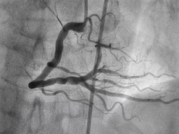 koronare angiographie , rechte koronare angiographie - human heart heart attack x ray image chest stock-fotos und bilder