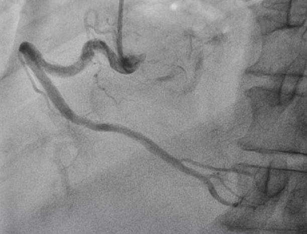 koronare angiographie , rechte koronare angiographie - human heart heart attack x ray image chest stock-fotos und bilder