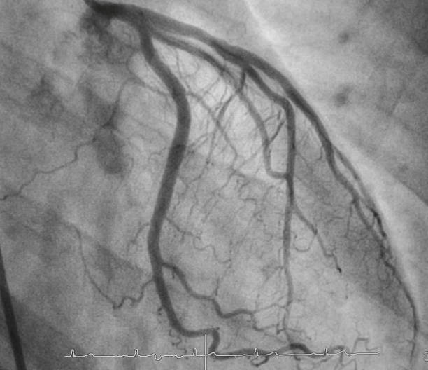istock Coronary angiography , left coronary angiography 1225384946