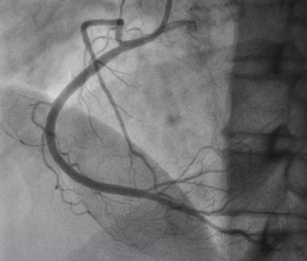 koronare angiographie , rechte koronare angiographie - human heart heart attack x ray image chest stock-fotos und bilder