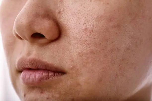 Skin problem with acne diseases, Close up woman face with whitehead pimples on mouth, Scar and oily greasy face, Beauty concept.