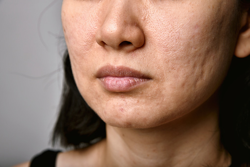 Problema de la piel con enfermedades del acné, Cara de mujer de cerca con la boca del labio seca, Cicatriz y cara grasa grasa, Concepto de belleza. photo