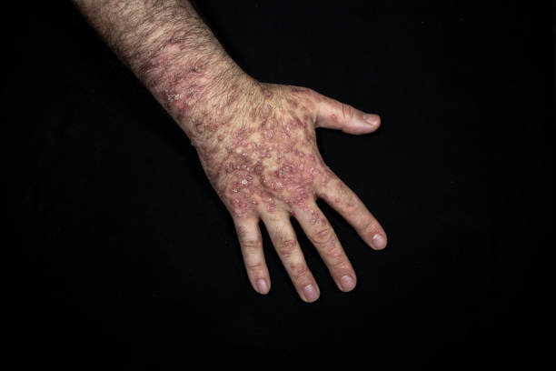 istock Psoriasis (eczema) on the hand isolated on black background 1225419020