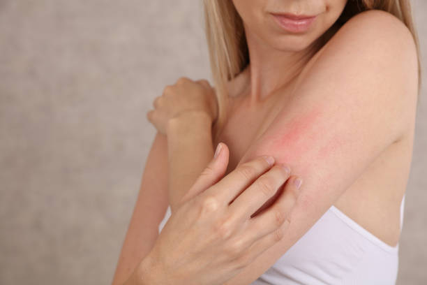 Woman Scratching an itch close up . Sensitive Skin, Food allergy symptoms, Irritation stock photo