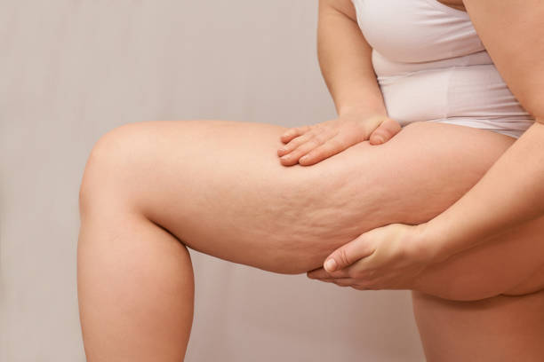 cellulit nogi kobieta szczypta. test tłuszczu biodra leczenia. liposukcja z nadwagą. usuń rozstępy - ludzka noga zdjęcia i obrazy z banku zdjęć