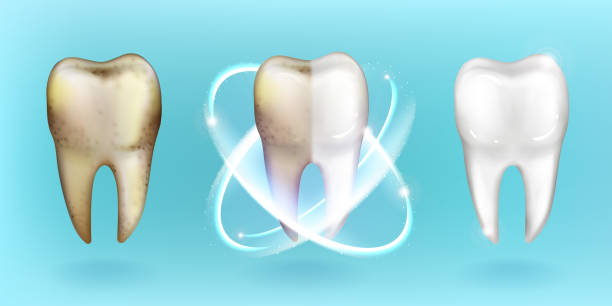 illustrazioni stock, clip art, cartoni animati e icone di tendenza di dente pulito e sporco, sbiancamento o sbiancamento dei denti - sbiancamento dentale