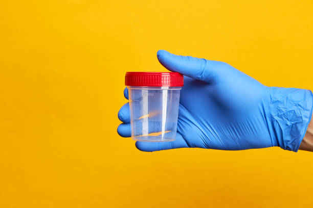 concetto di esame medico. persona tiene la tazza di prova delle urine su sfondo giallo brillante. - doping test foto e immagini stock