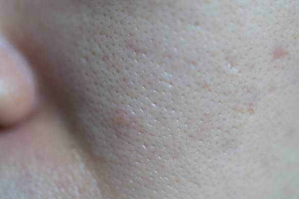 istock Problematic skin with deep acne scars on cheek. Concepts of beauty. 1225677913
