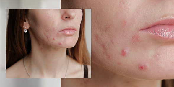 Close up of a woman's skin with acne eruptions. Treatment of blackheads.