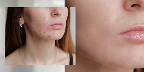 Collage before and after healthy skin and skin in adolescent acne.