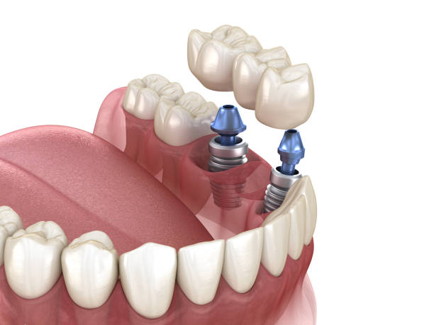 istock Dental bridge supported by implants. Medically accurate 3D illustration of human teeth and dentures concept 1225928164