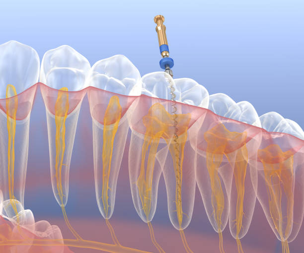 endodontische wurzelkanalbehandlung. medizinisch genaue zahn 3d-illustration. - abszess stock-fotos und bilder