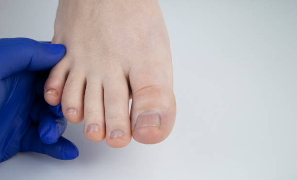 医師のポドロジストは、女性の足の爪の真菌を調べます。爪真菌症、真菌症の治療。変形したネイルプレート - pedicure podiatrist human foot toenail ストックフォトと画像