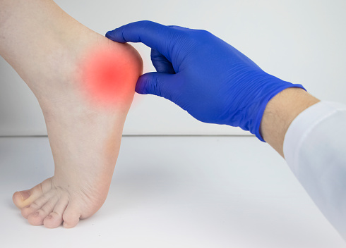 Un médico ortopédico examina la pierna de una mujer. Dolor en el talón, estiramiento del tendón, inflamación, espolón en el talón. Concepto de tratamiento de la enfermedad del pie photo