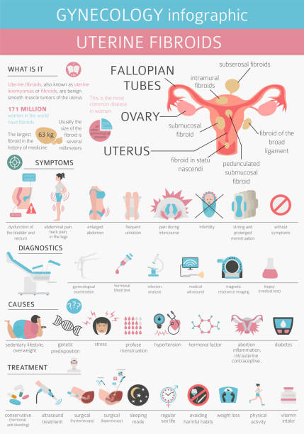 Uterine fibroids. Ginecological medical desease in women infographic Uterine fibroids. Ginecological medical desease in women infographic. Vector illustration woman ovarian cancer stock illustrations