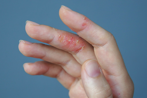 Dermatitis de manos atópica. Eccema en los dedos. photo