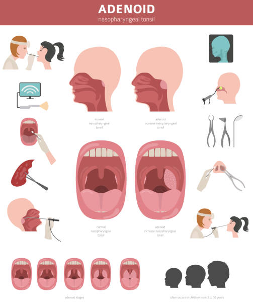 Nasal and throat, nasopharynx diseases. Adenoids diagnosis and treatment medical infographic design Nasal and throat, nasopharynx diseases. Adenoids diagnosis and treatment medical infographic design. Vector illustration tonsil stock illustrations