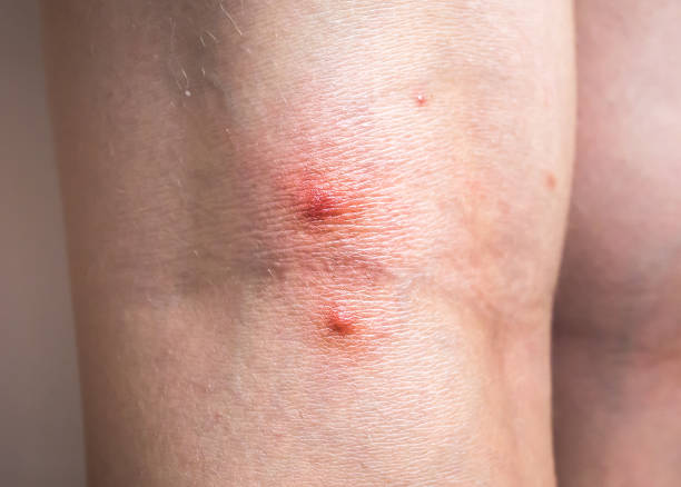 istock Mosquito bite on woman's leg. Skin health problem. Red pimple. 1226359621