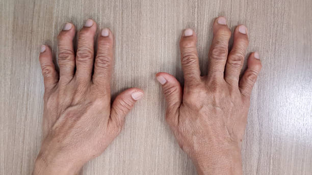 手の解剖学は変形性変形性関節症(oa障害)の変形を示す。患者は指関節関節炎、痛みおよび剛性の問題を有する。医療診断技術と検査コンセプト。 - deformed ストックフォトと画像