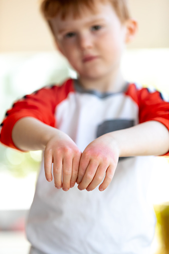 A little redhead boy is showing the sunburn he has on his hands. His hands are very red and dry.