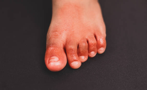 Painful red inflammation on toe called covid toe lesions strange sign of new coronavirus symptoms or infections Painful red inflammation on toe called covid toe lesions strange sign of new coronavirus symptoms or infections. toe stock pictures, royalty-free photos & images