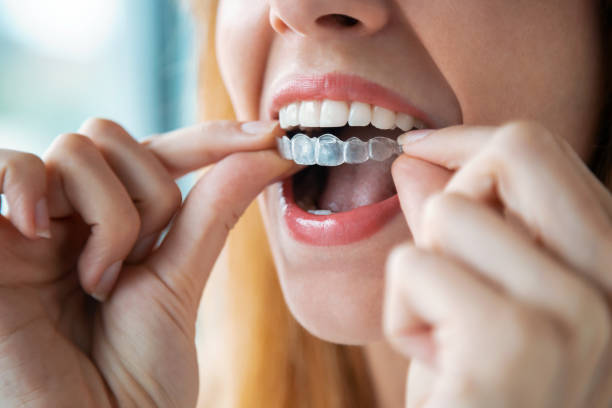 woman wearing orthodontic silicone trainer. invisible braces aligner. - human teeth whitening dentist smiling imagens e fotografias de stock