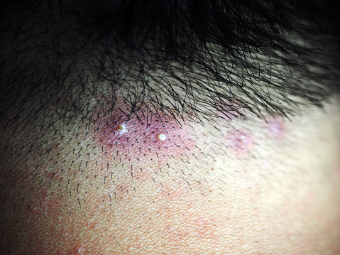 inflamed pus pimples on head scalp, hair follicles acne