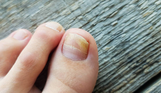 plan rapproché d’une jambe avec un champignon sur des ongles sur un fond en bois. onycholysis: exfoliation de l’ongle du lit d’ongle. - toenail photos et images de collection