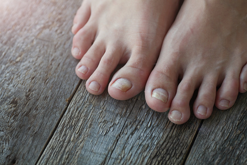 Primer plano de las piernas con hongos en las uñas sobre fondo de madera. photo