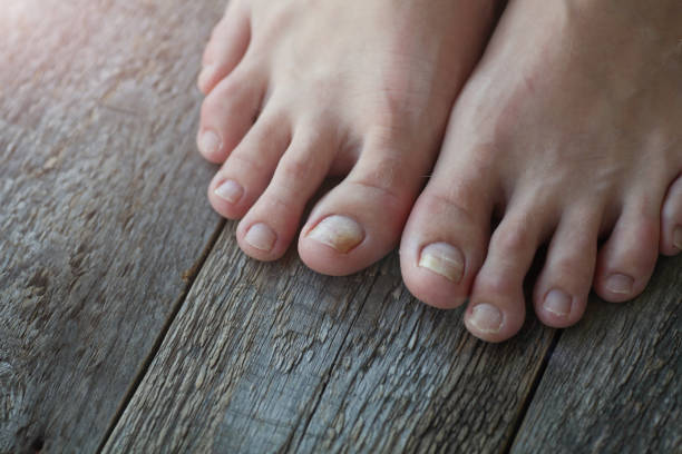 primo piano delle gambe con fungo su chiodi su sfondo di legno. - toenail foto e immagini stock