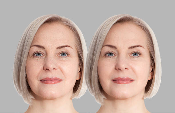 Woman middle age face before and after collagen face injection. Wrinkle anti aging concept. Beauty cosmetic procedures. nasolabial folds facelift. Old female face macro. Skin care before-after Woman middle age face before and after collagen face injection. Wrinkle anti aging concept. Beauty cosmetic procedures. nasolabial folds facelift. Elderly female face macro. Skin care before-after botox before and after stock pictures, royalty-free photos & images