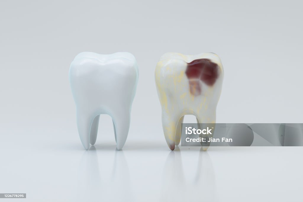 白い歯、3Dレンダリングと横に虫歯。 - 歯のロイヤリティフリーストックフォト