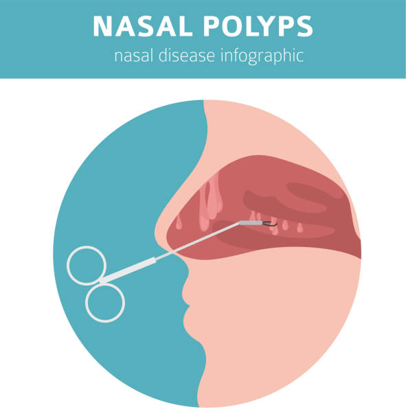 illustrazioni stock, clip art, cartoni animati e icone di tendenza di malattie nasali. cause dei polipi nasali, diagnosi e trattamento progettazione infografica medica - cnidarian